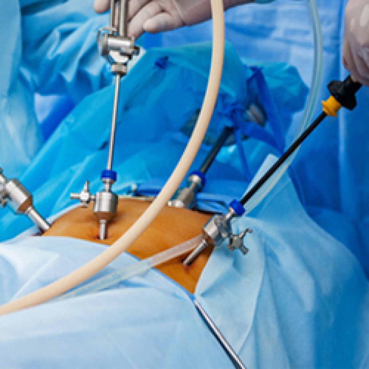 Best Laparoscopic Surgery in Hyderabad | Best Laparoscopy Specialists in  Hyderabad